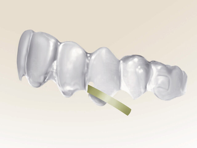 TEAR DROP je navržen k tvorbě výřezů ve tvaru slzy na hranách fóliových aparátů pro zavěšení ortodontických elastických tahů.