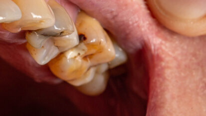 El 94% de los adultos en España tiene caries