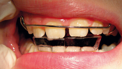 Ugroženo zdravlje pacijenata sa protezom usled povećanog broja mikroba