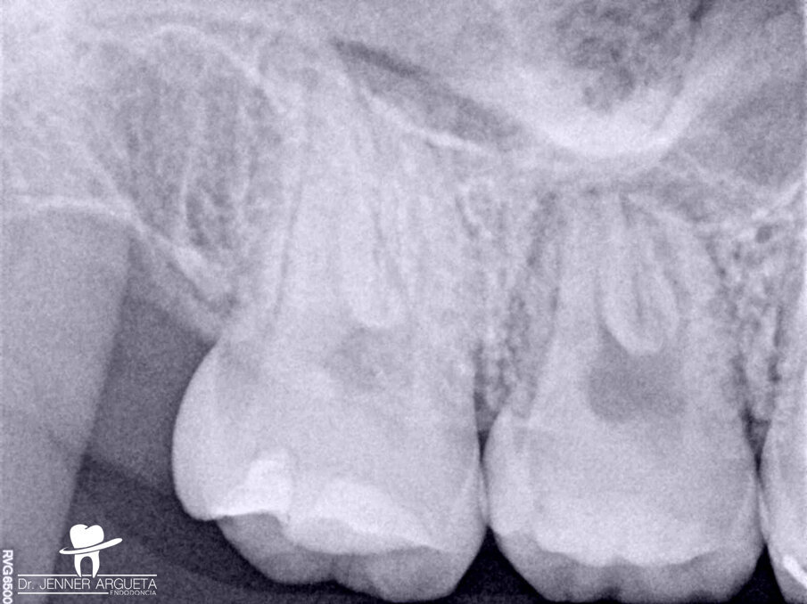 Fig. 6:
Eight-month post-op radiograph. The retromolar area had healed, but the transplanted tooth showed signs of pulp necrosis and periapical disease.