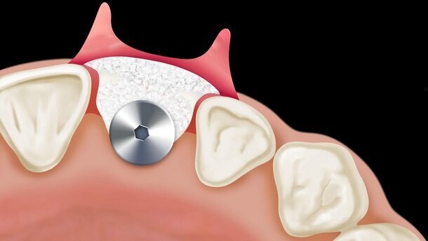 Analisi critica dei fattori di rischio estetici in implantologia post-estrattiva e introduzione di un nuovo parametro clinico-diagnostico