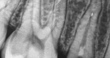 Uklanjanje zalomljenih kanalnih instrumenata – prikaz dva slučaja