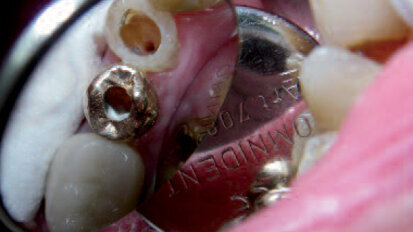 Kořen ve tvaru písmene S – rizika této velké výzvy v endodoncii