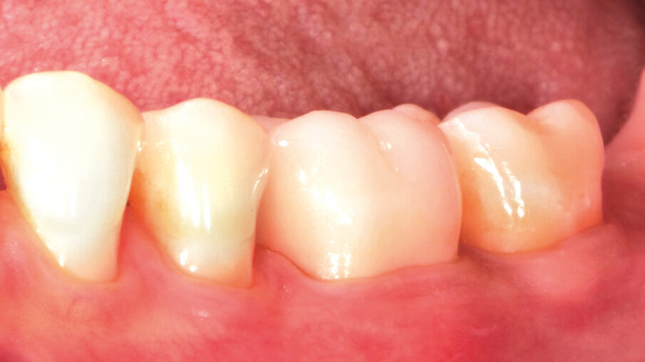 Fig. 12: At the check-up several days after crown placement, a great overall picture is obtained. The patient is happy with the final restoration in terms of aesthetics and function.