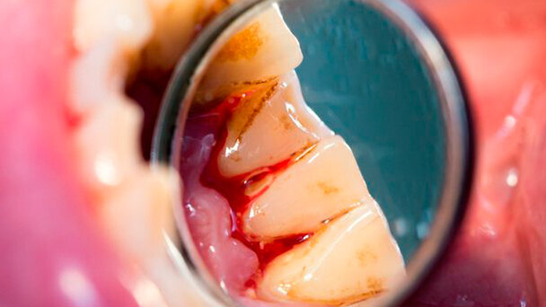 Parodontite legata a un tasso di mortalità più elevato nei pazienti con cirrosi epatica