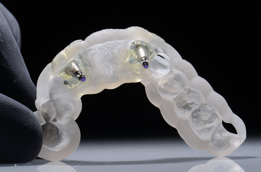 Fig. 36 - Dima protesica e transfert bloccati.