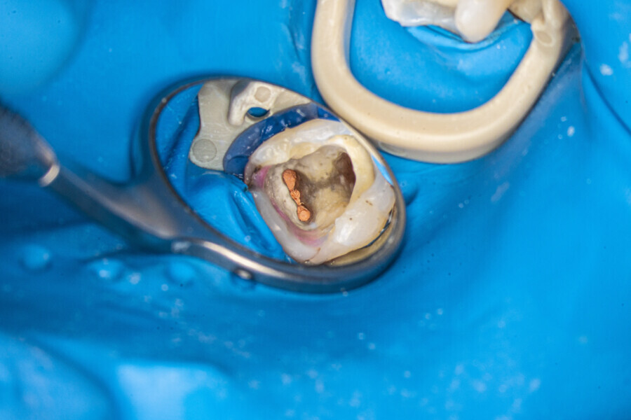 Fig. 22: Pulp chamber after obturation.