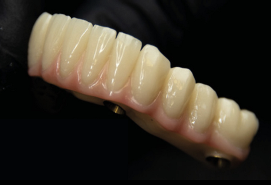 Fig. 10 : Bridge G-CAM fini en un seul bloc avec bagues de collage à l’intrados.