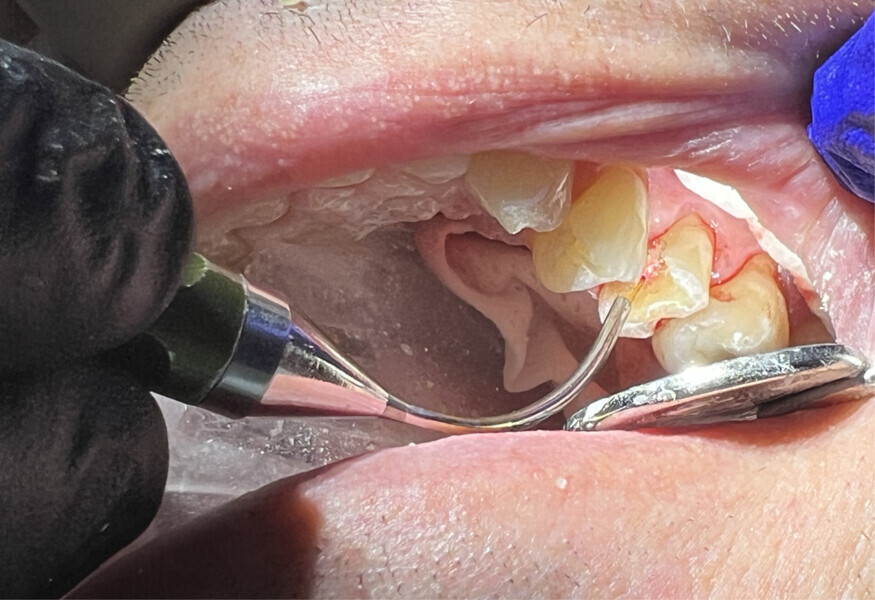 Fig. 6: Treatment of the pulpal exposure with the Nd:YAG laser to eliminate any bacteria that may have led to pulpal infection that would have necessitated endodontic treatment.