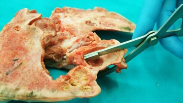 Przyczyny perforacji błony Schneidera podczas podnoszenia dna zatoki szczękowej metodą zamkniętą