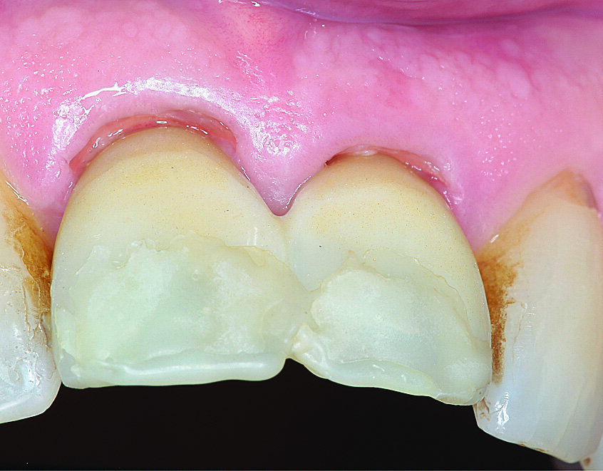 Slika 8. Prvi dan postoperativno: vestibularna ljuska jasno je vidljiva