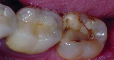 STOP aux sensibilités postopératoires sous les restaurations - séance interactive