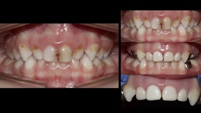 Caries severa de primera infancia en odontopediatría