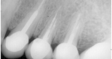 La importancia del tercio apical del conducto