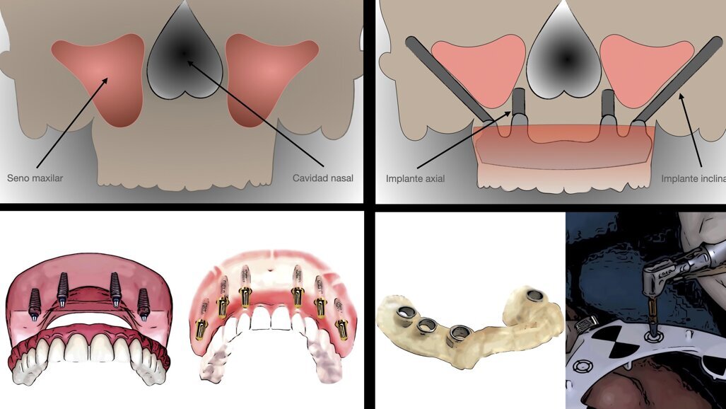 Carga inmediata o diferida en el maxilar totalmente edéntulo