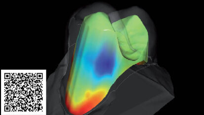Vedci vyvíjajú softvér na zlepšenie nasadenia koruniek na zuby