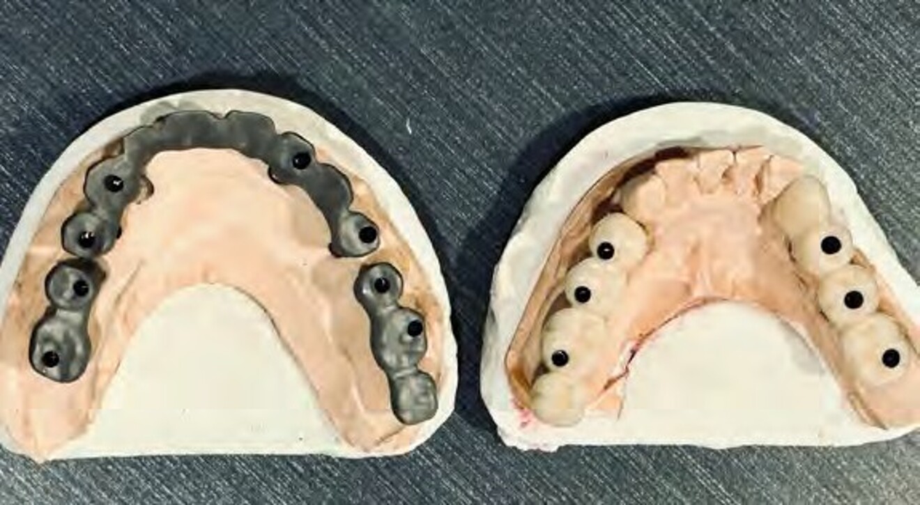 Fig. 2a: Definitive maxillary and mandibular implant impressions obtained using the closed-tray impression technique with polyether impression material following soft tissue healing.