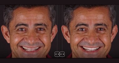 Colocación de restauraciones cerámicas adhesivas en la zona estética (1)