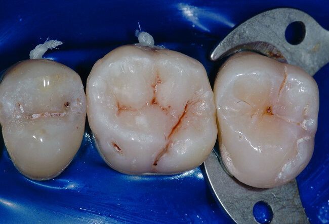 Figs. 30 et 31 :
Vue après polissage de la restauration. Le champ opératoire peut alors être déposé afin de réaliser les derniers réglages occlusaux.