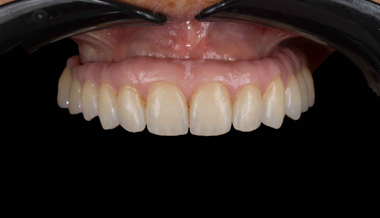Fig. 14: Intra-oral frontal view of the final result after insertion of the prosthesis.