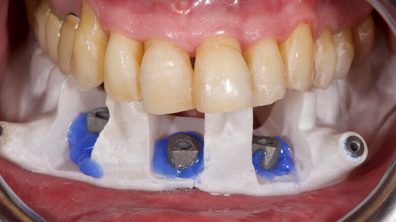 Extraoral digitalization: A digital protocol for surgical treatment of edentulous patients