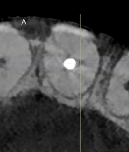 Fig. 2: Location of the furcation.