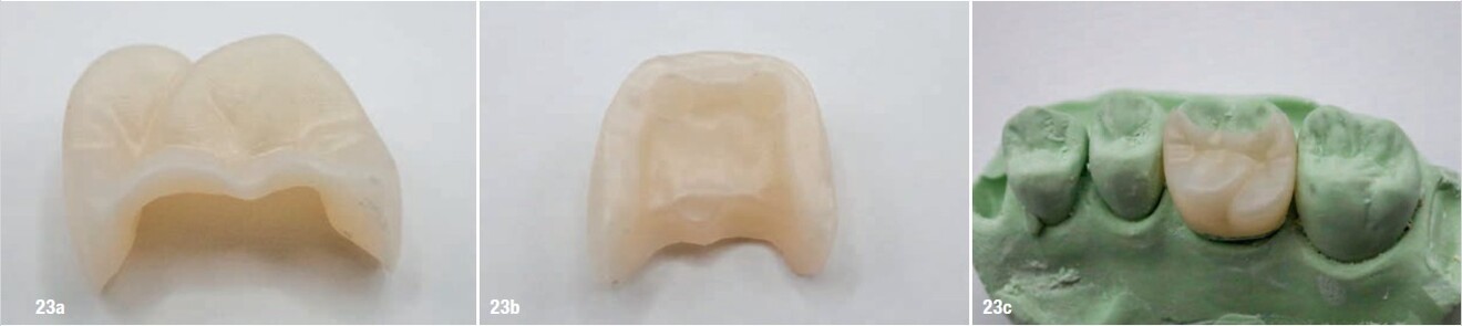 Figs. 23a–c: Milled zirconia pinlay for tooth #26, shown in the occlusal view (a) and internal view with two pin spaces (b), and fitted on the cast (c).