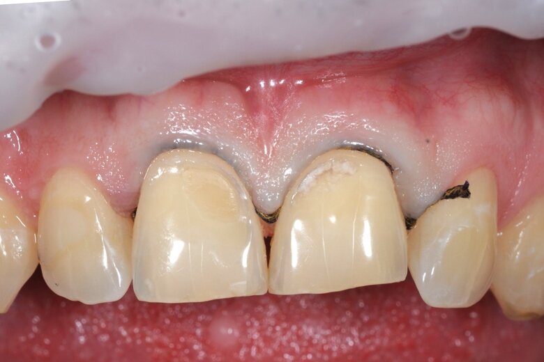 Fig. 1 Pretreatment.