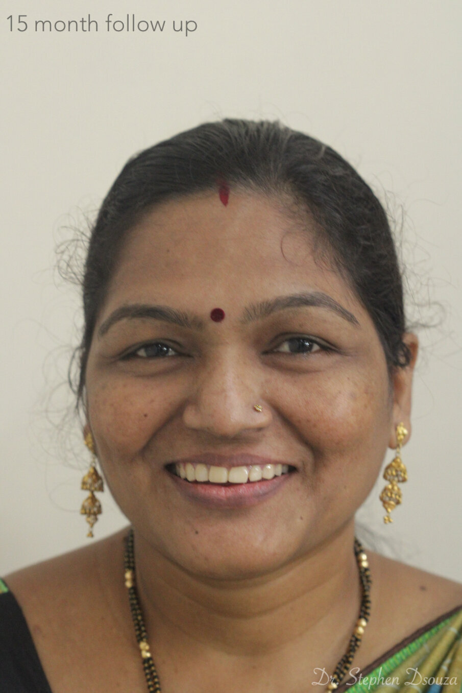 Fig. 18: After 15 month follow up. 