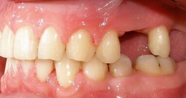 Izmeštanje zuba može biti alternativa transplantaciji koštanog tkiva vilice