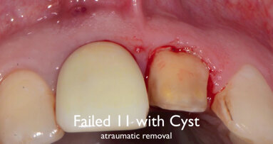 Τοποθέτηση μοσχεύματος ethoss και εμφυτεύματος Paltop Conical Connection.