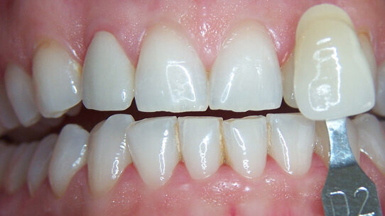 Lo sbiancamento come terapia cosmetica “strumentale”