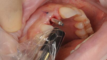 Interview: “ISQ is one of the key indicators for immediate loading when desired” Interview: “ISQ is one of the key indicators for immediate loading when desired”