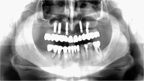 RTG finální nasazené práce