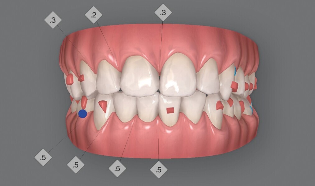 Fig. 4c : Premier résultat prévu par simulation ClinCheck.