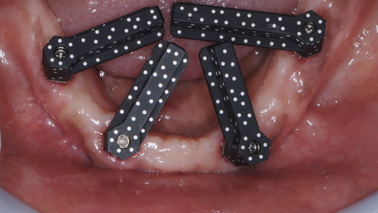 Fig. 17a: Photogrammetric scan bodies connected to the implants for definitive digital impression taking in the mandible.