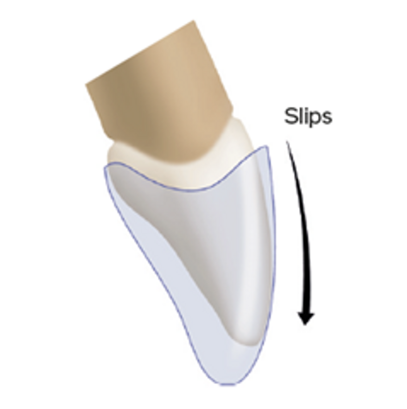 Fig. 1: Grip on teeth for aligners with gingival scalloping.