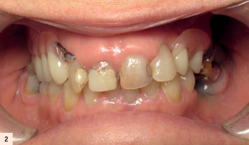 Stellite remplaçant 9 dents.