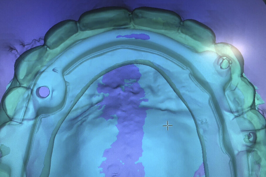 Fig. 13: Provisional prosthesis in place.