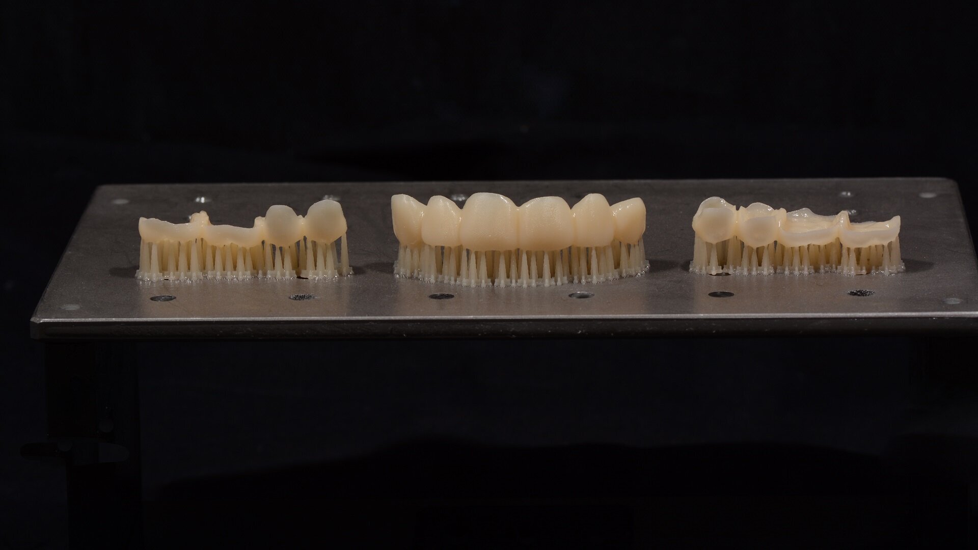 3D-printed provisional restorations for complex prosthetic rehabilitation: Full-mouth restoration of a severe case of erosion