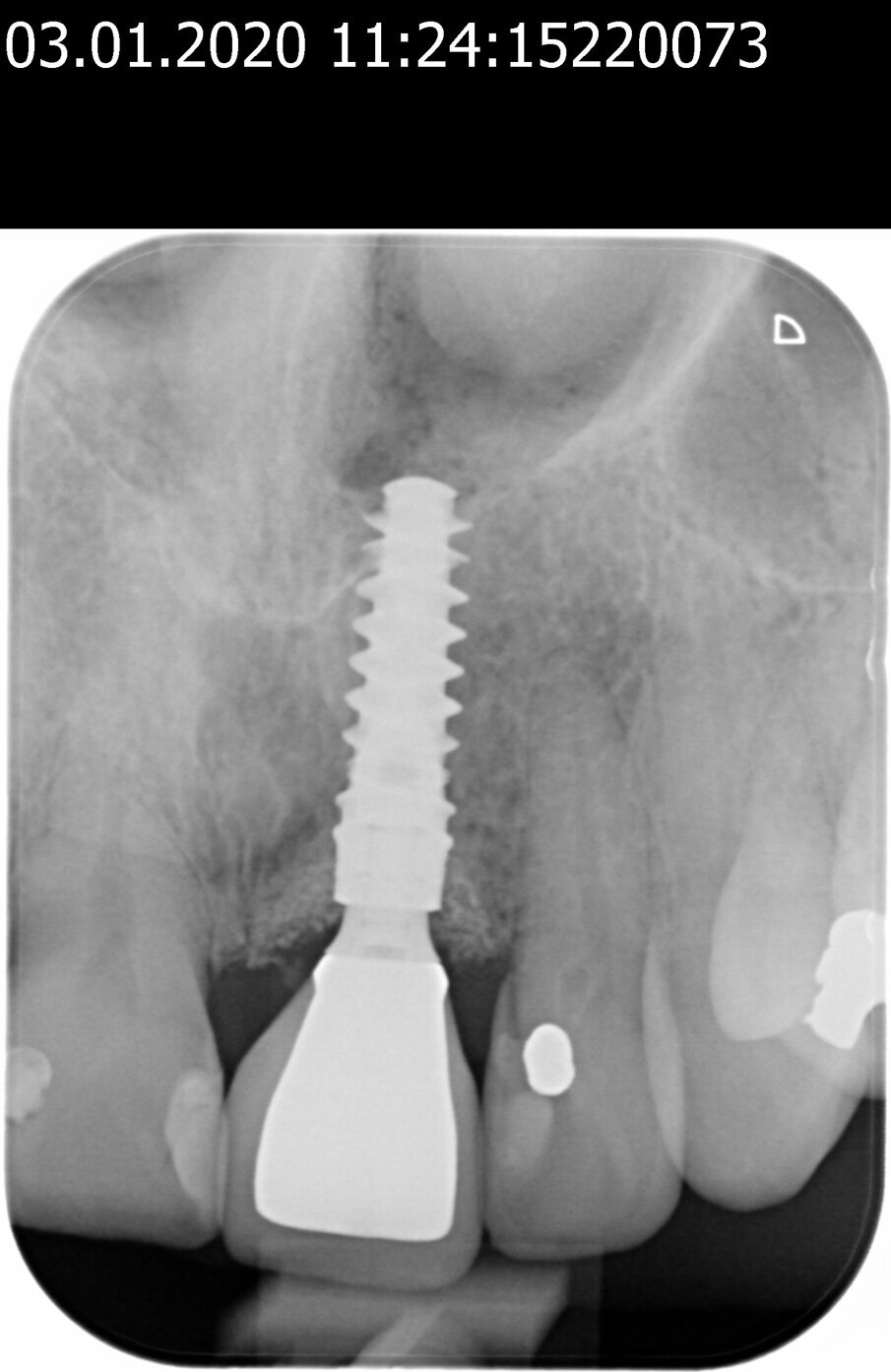 Fig. 33_Radiografia finale.
