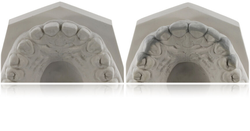 Fig. 32: Comparison of the pre-op
situation and final wax-up.