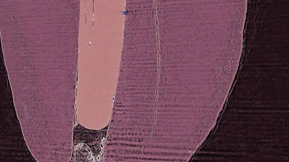 Studie zu Frakturen durch Aufbereitung der Zahnwurzel