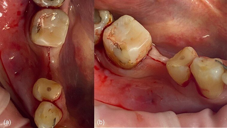 Fig. 3_Progetto dell’incisione nel sito 46: a) vista occlusale, b) vista vestibolare.