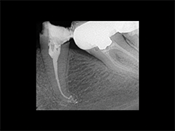 Slika 4:Kompleksnost apikalne regije pokazana nakon hemijske obrade kanala, sušenja i zaptivanja tehnikom vertikalne kondenzacije.