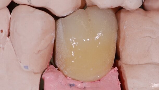 Algorytmy postępowania dla wykonywania indywidualnych rozwiązań protetycznych – część 1