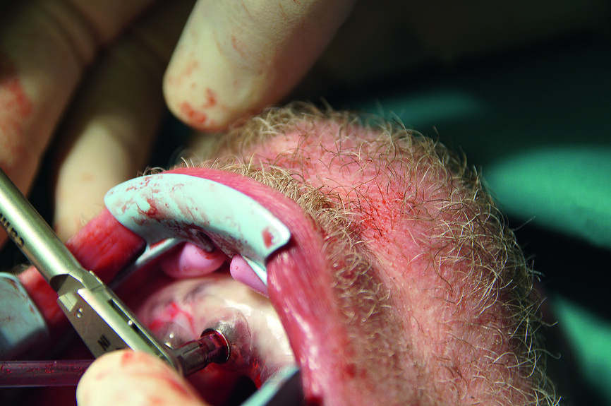 Fig. 17 : Insertion manuelle de l’implant CAMLOG au moyen de la clé dynamométrique verrouillée.