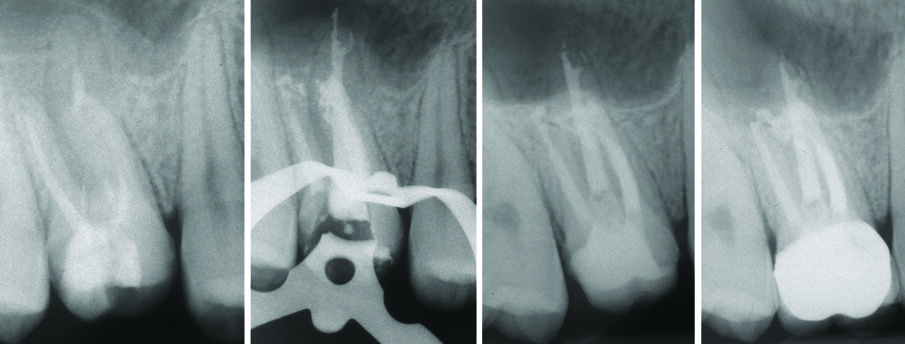 Fig. 12 - Ritrattamento canalare 1.6 controllo a 10 anni.
