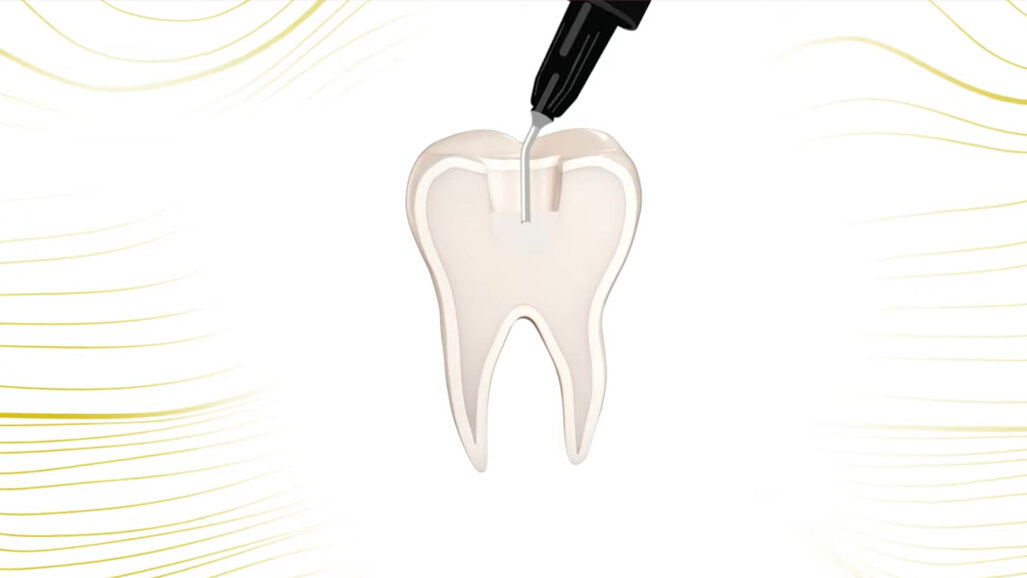 COLTENE – BRILLIANT Bulk Fill Flow - Aesthetic and durable restorations saving time and money