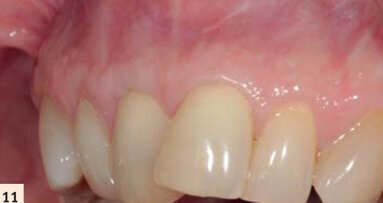 Technique innovante dans le recouvrement des racines dentaires : Le concept FASTP